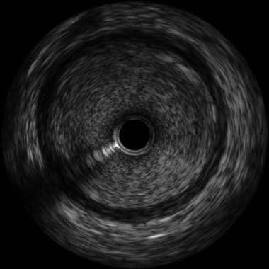 A still intravascular ultrasonography image demons