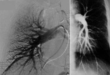 Normal right (A) and left (B) pulmonary angiograms