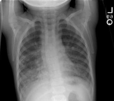 Posteroanterior chest radiograph of a child with b