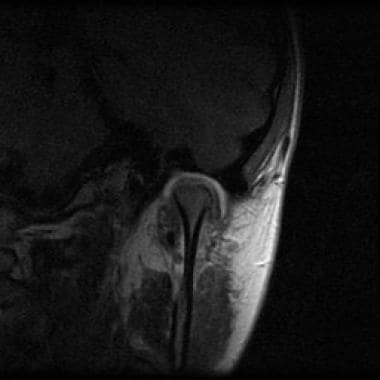 Temporal-mandibular joint (TMJ) MRI postgadolinium