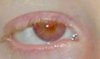 Photo showing light brown eyes and a red reflectio