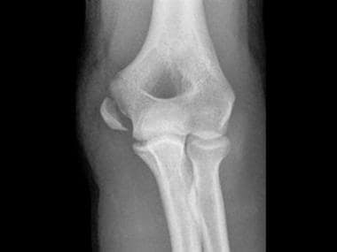 Growth Plate Fractures (Physeal Fractures) Treatment & Management ...