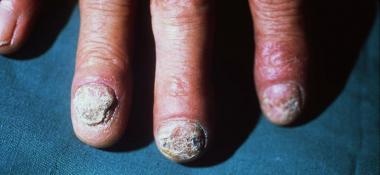 Thickened, fragmented, hyperkeratotic nails and er