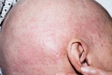Diffuse macules and papules on the scalp of a pati