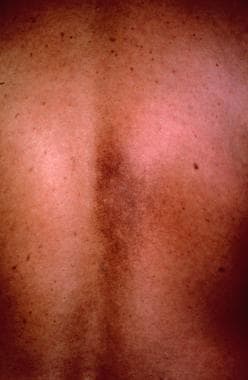 Reddish brown patch on the back characteristic of 