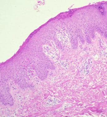 Histopathologic features of pityriasis rosea. Imag