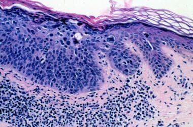 Histologic features of actinic keratosis in an ind
