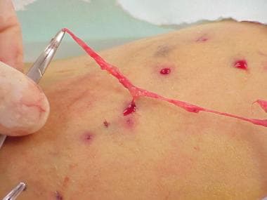 icarus deep vein extraction