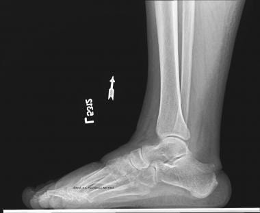 Lateral radiograph at 3-month follow-up showing co