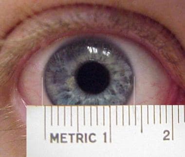 Megalocornea. 