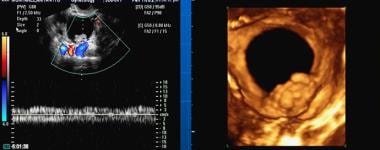 3D transvaginal sonography of ovarian cancer. Mult