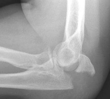 Transverse olecranon fracture without comminution.