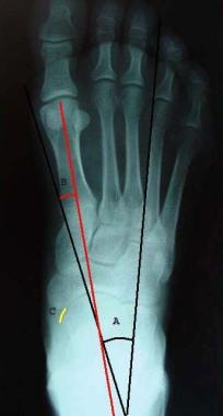 Anteroposterior view demonstrating talocalcaneal a
