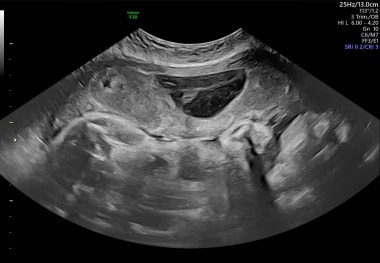 Abruptio Placentae Workup: Approach Considerations