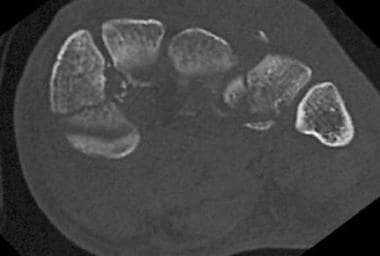 CT scan in the coronal plane can demonstrate the e