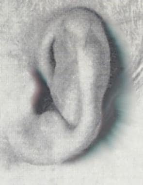 Ear deformity in a patient with diastrophic dyspla