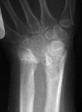 Preoperative wrist posteroanterior radiograph of a