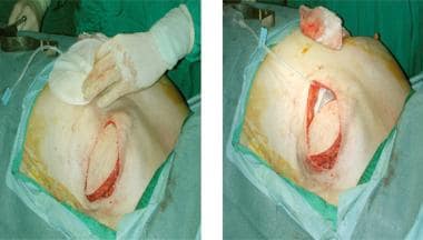 Latissimus dorsi breast reconstruction; implant pl
