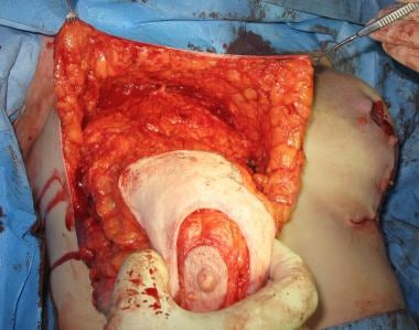 The gland is entirely denuded on its anterior aspe