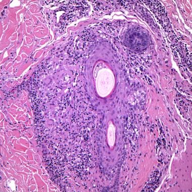 A dense perifollicular infiltrate is composed of l