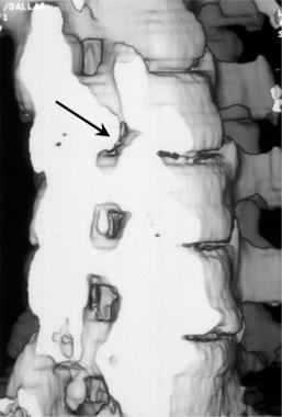 斜三维阴影面显示CT re