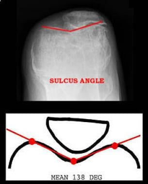 Patellofemoral arthritis. The sulcus angle is the 