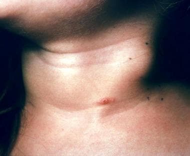 A crusted primary inoculation papule on the neck o