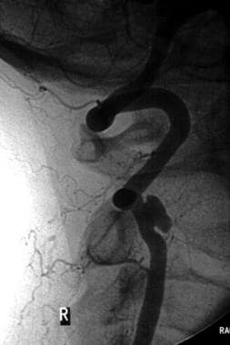 Selective angiogram of a right vertebral artery ps