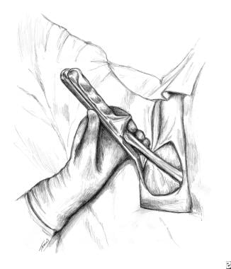 An illustration of upward traction. 
