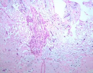 Low-power photomicrograph of cardiac myxoma (hemat