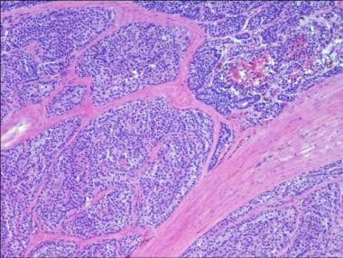 Photomicrograph of parathyroid carcinoma showing t