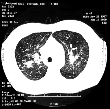 Restrictive lung disease secondary to sarcoidosis.