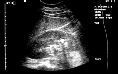Renal sonogram demonstrating renal calculi in the 
