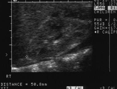 Ultrasound image of a normal right kidney in a chi