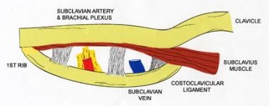 Thoracic Outlet Syndrome (TOS) (Folder) - Catharina Ziekenhuis