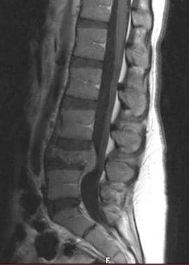 MRI of plain film above showing intrusion of tumor