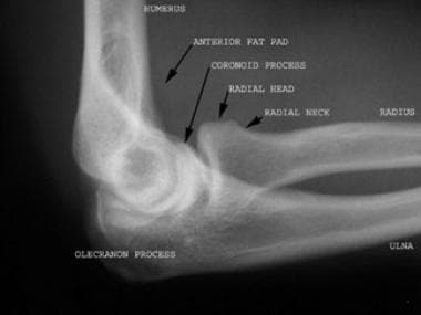 posterior elbow dislocation