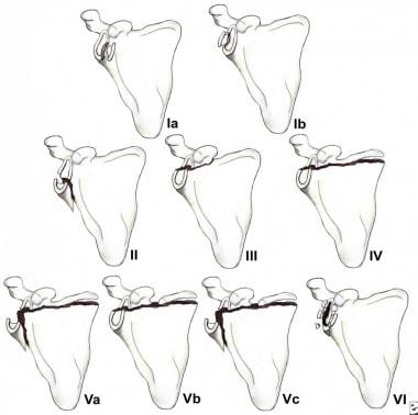 Classification of glenoid cavity fractures: IA - A