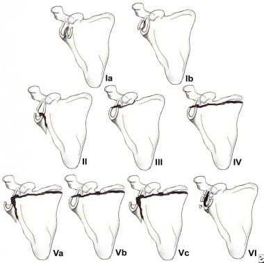 Classification of glenoid cavity fractures: IA - A