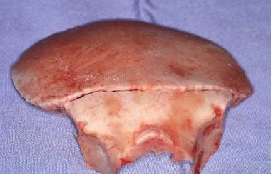 Craniotomy and supraorbital block removed as separ