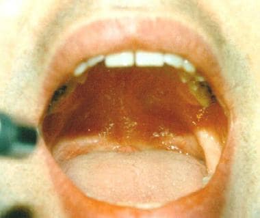 Thirty-two-year-old man with a submucosal lesion a