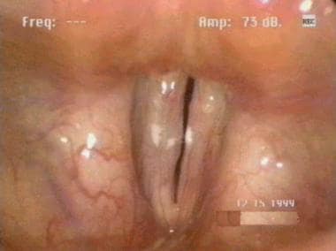 This patient underwent right mucosal stripping for