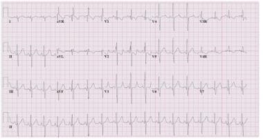 Electrocardiographs (ECGs) from a child with a sec