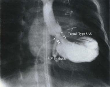 Tunnel-type of subaortic stenosis (subvalvular aor