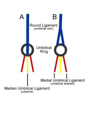 Variations in the umbilical ring structure. (A) Us