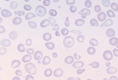Peripheral blood film in thalassemia intermedia. 
