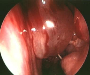 Endoscopic view of the left middle meatus. The sep