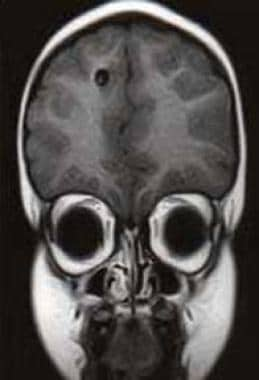 Case 1: Coronal image MRI of a 6-year-old boy from