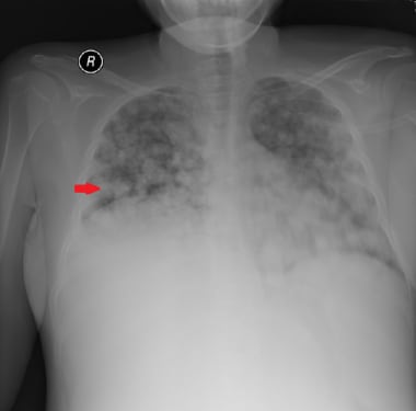 This 3- year-old patient presented with advanced-s