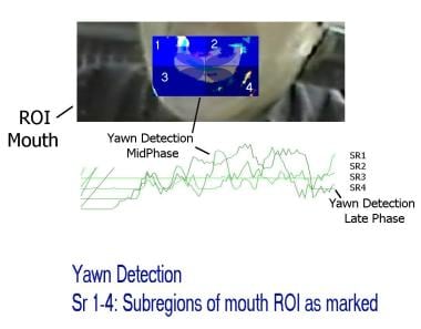 Physiologic yawn. Mouth region of interest (ROI). 